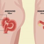 Hemorrhoids Symptoms Causes Foods